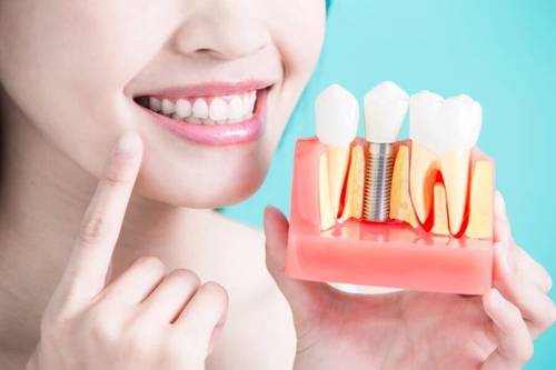 Имплантация зубов: важные особенности операции и её последствия