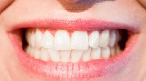 Ювелирная имплантация зубов