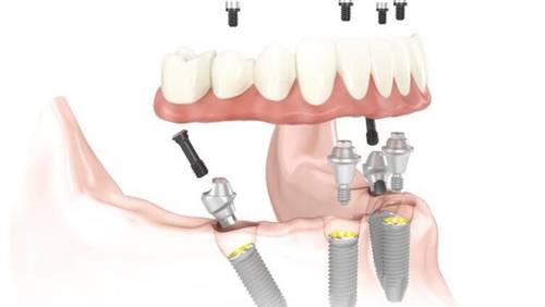 Имплантация зубов методом «All-on-four»