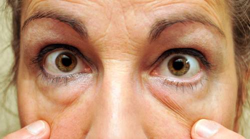 Как удалить мешки под глазами?