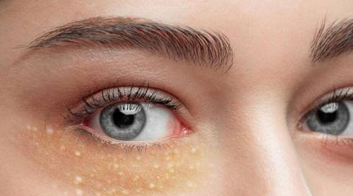 Милиумы на лице