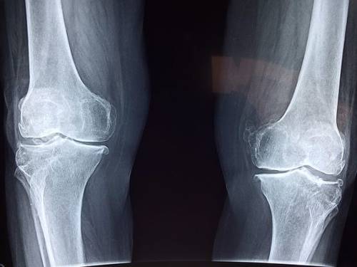 artroza tratamentul articulației genunchiului condroitina și glucozamina beneficiază și dăunează